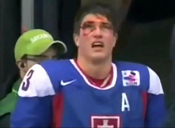 Huge Hit in Hockey Game Leaves Player Bloodied