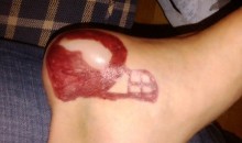 Dudes Blister Shaped Like Minnesota Vikings Logo (PIC)