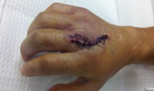 Picture Of The Day: Dominick Cruz’s Broken Hand