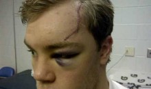 Here’s Taylor Hall’s Face After Being Cut By A Skate Blade (Pic)