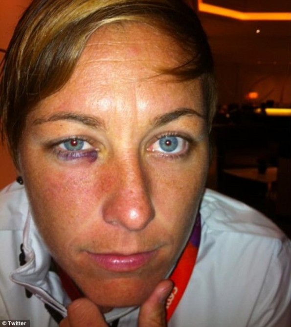 abby wambach black eye