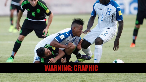 Honduran Soccer Player Suffers Horrifying Knee Injury ...