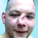 MMA Fighter Andy Eichholz Suffers Nasty Broken Nose