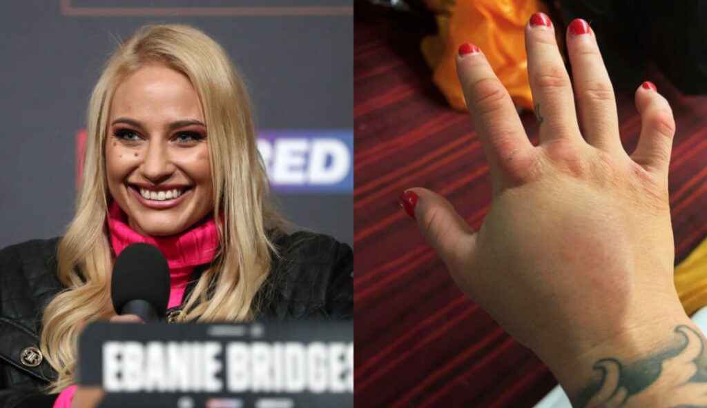 Ebanie Bridges smiling and her showing off broken hand