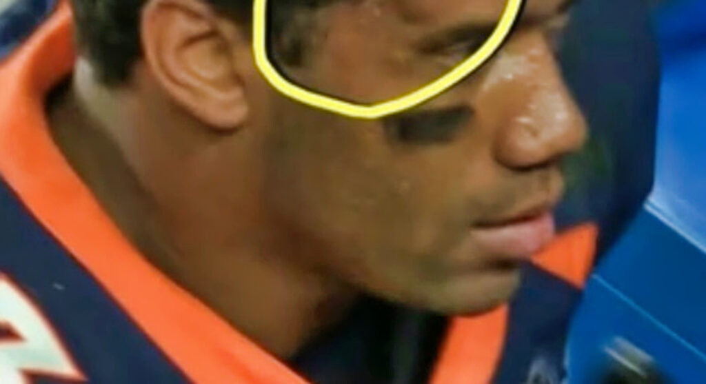 A large bump on Russel Wilsons head after a suspected concussion